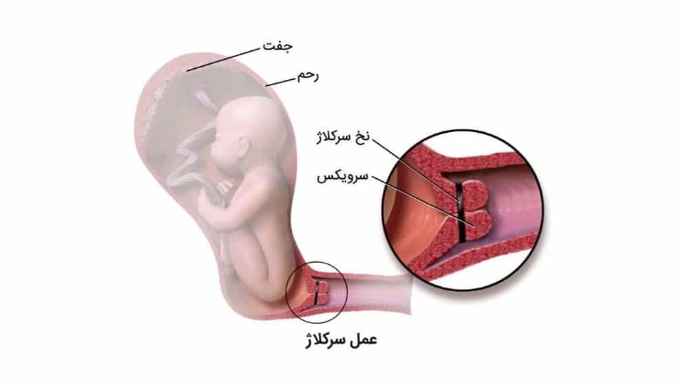 Cerclage