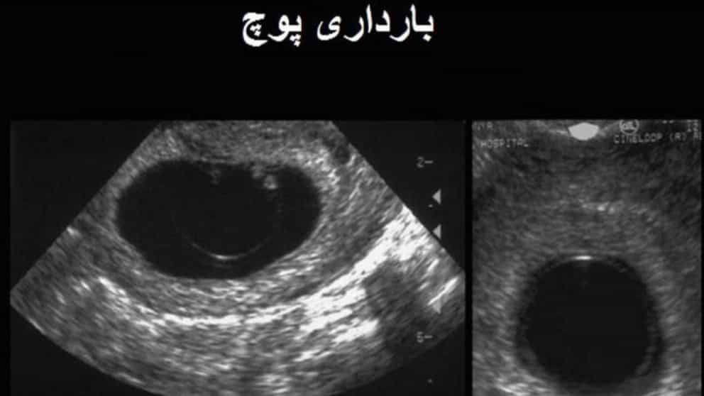 What are the symptoms of molar pregnancy?