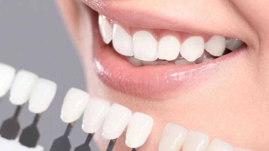 لمینت دندان چیست و چه کاربردی دارد؟