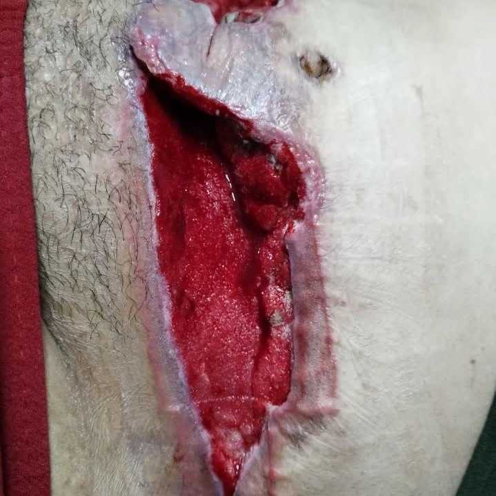 وکیوم تراپی