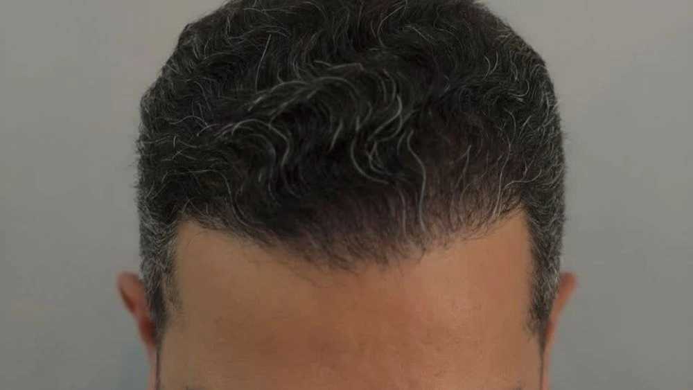 Rasht Royan Transplantation Center, specialized hair and eyebrow transplant services by micrograft method