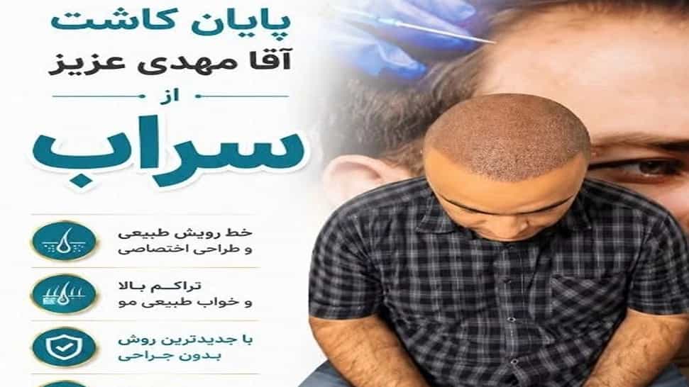 Cost of hair transplant in Tabriz with Rahimi clinic