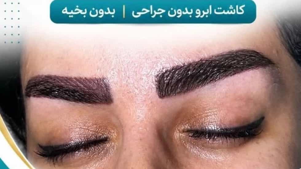 Eyebrow transplant services at a reasonable price in Tabriz