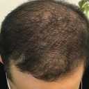 Hair transplantation, hair and eyebrows in Tehran