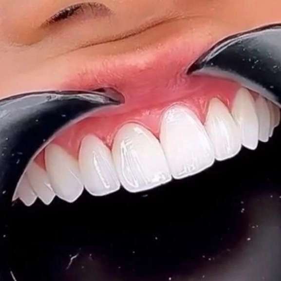 کامپوزیت نانو سرامیک دندان