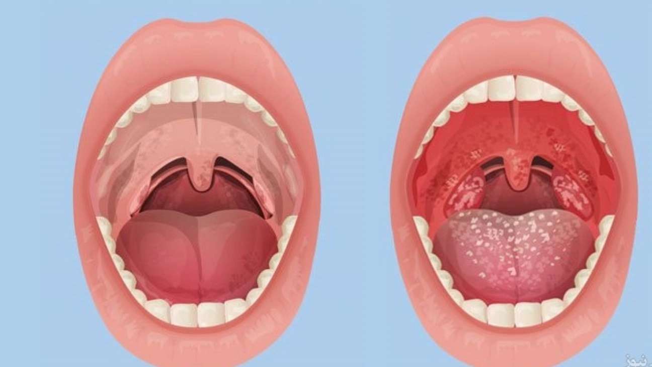 Diagnosing the disease from the tongue