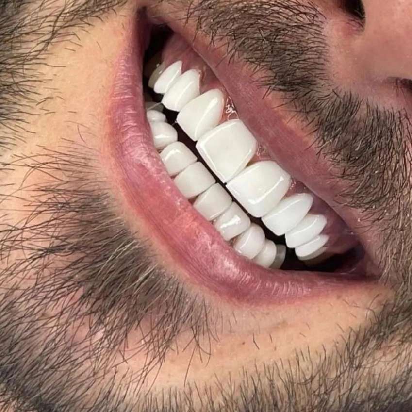 کامپوزیت نانو سرامیک دندان