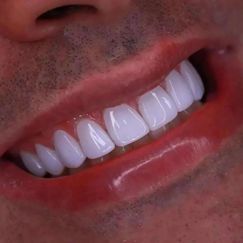 کامپوزیت نانو سرامیک دندان