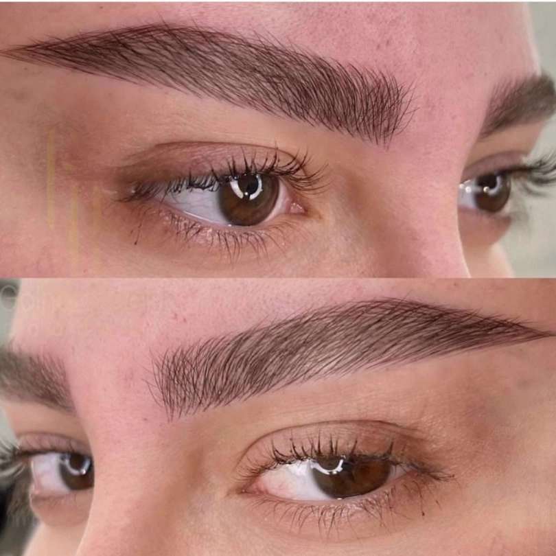 میکروبلیدینگ وتاتوحسینی