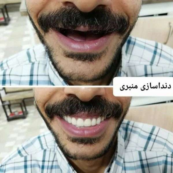 دندانسازی بیستون منبری