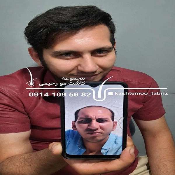 کاشت مو ارزان