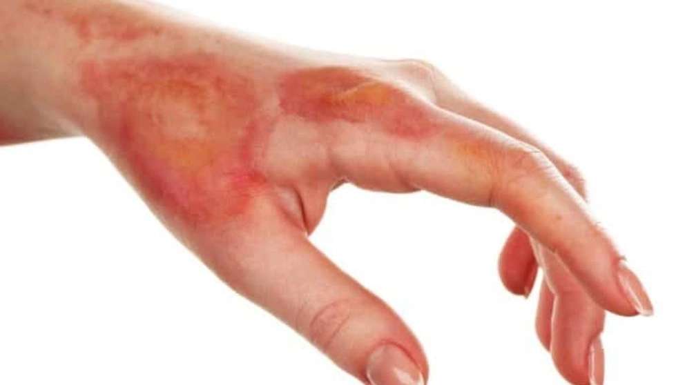 New burn dressing