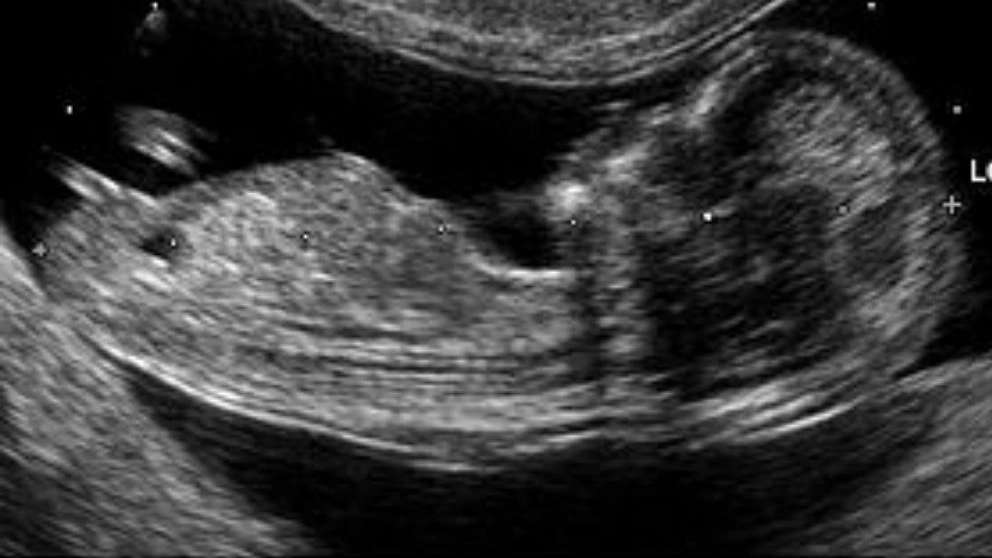Three and four-dimensional color ultrasound
