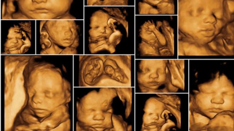 Three and four-dimensional color ultrasound