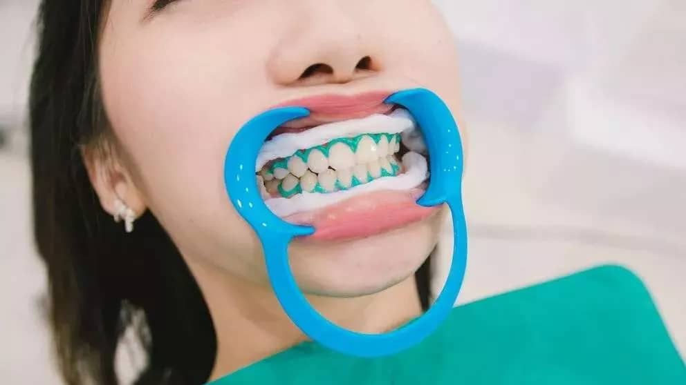 علل تغییر رنگ دندانها