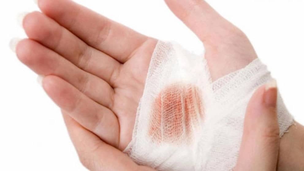 نحوه استفاده از بتادین برای زخم ها