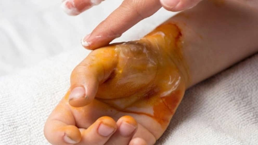 نحوه استفاده از بتادین برای زخم ها