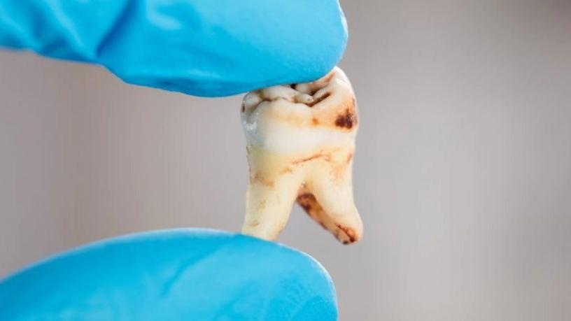 How does tooth decay occur?