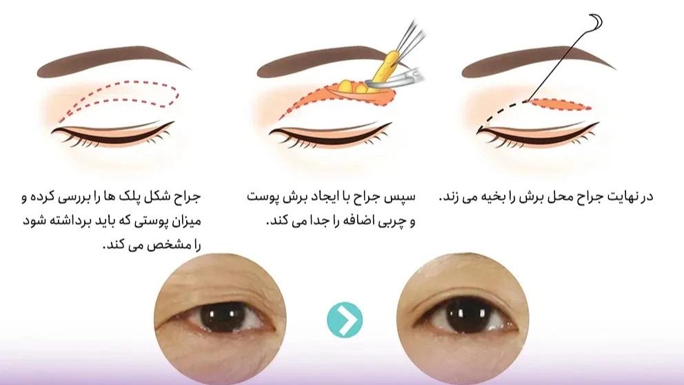 ما هو رأب الجفن؟