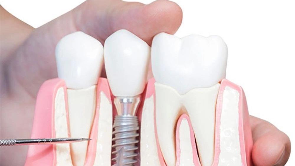Alireza Jamali'nin diş implantı