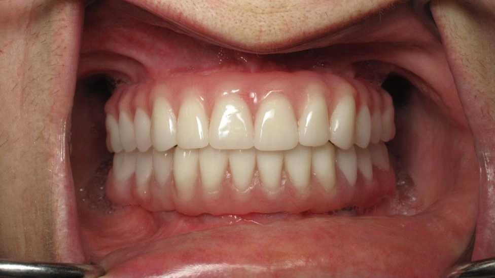 پروتز دندان چیست؟