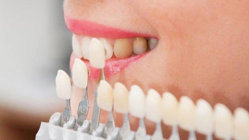Dental laminate