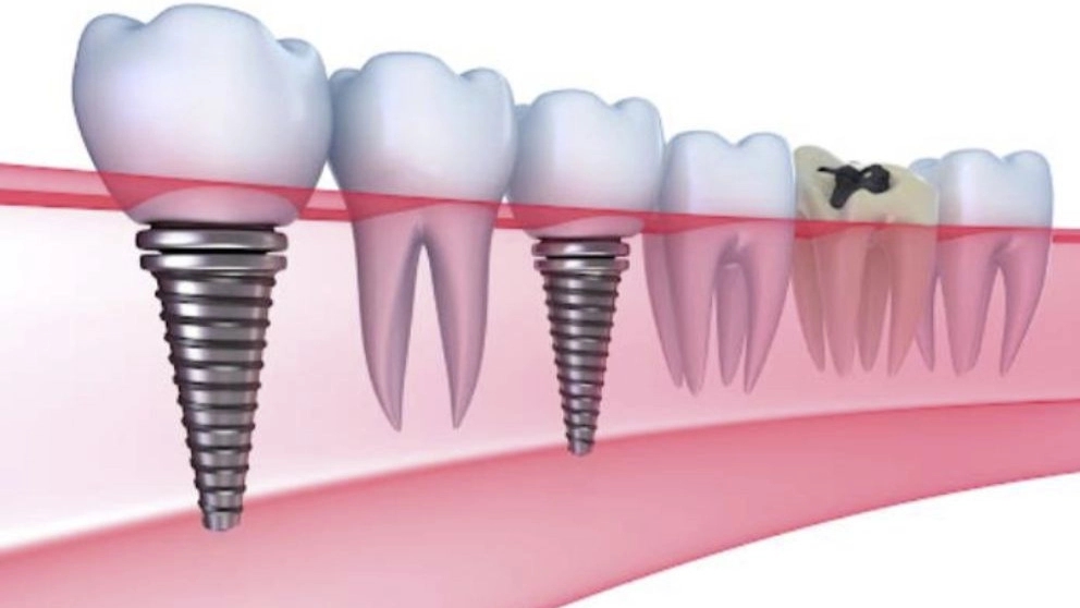 ماخ لطب الأسنان، مركز ماخ لتركيب الأسنان الاصطناعية في طهران
