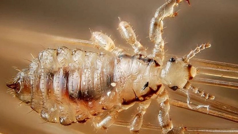 Definitive treatment of head lice in Tehran