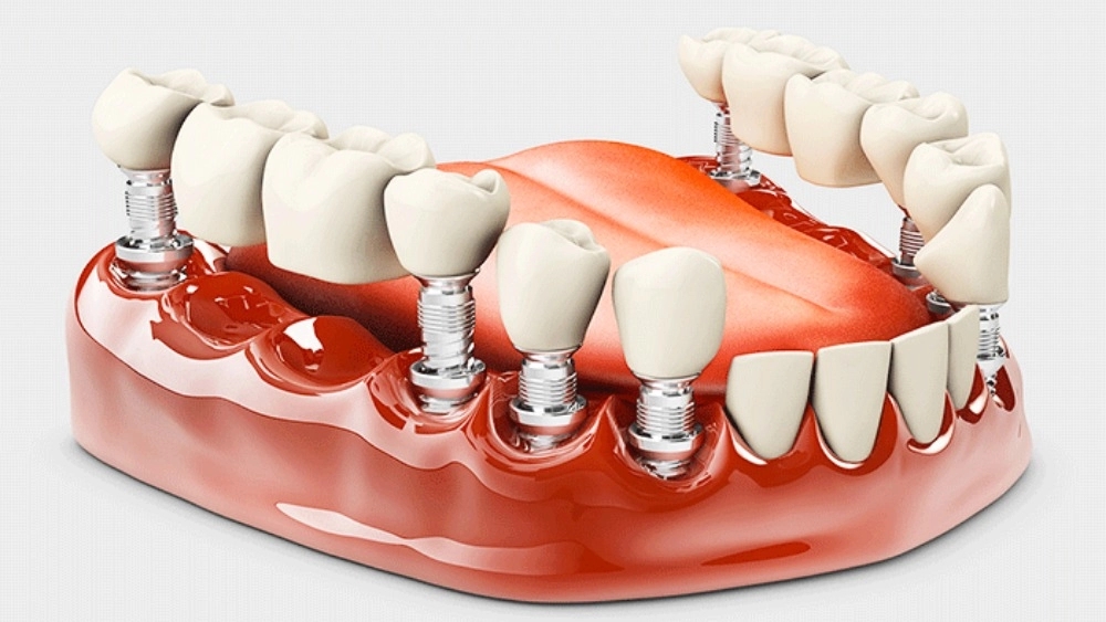 Dental prosthesis